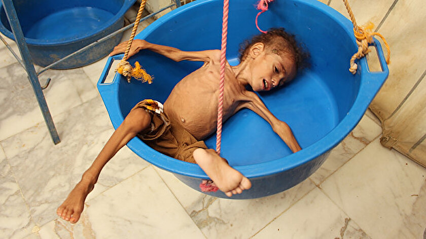 Yemen'de açlıktan ölmesinden korkulan çocuklardan sadece biri.