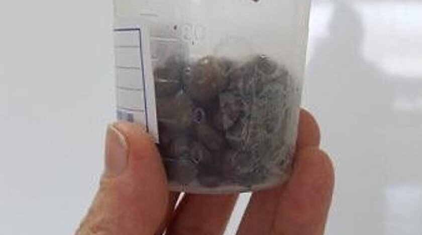 Hastanın böbreğinden 120 adet taş çıktı.