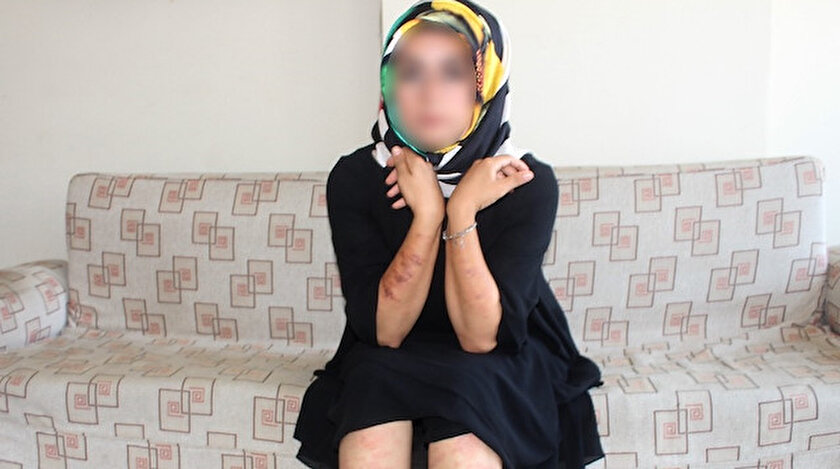 Adıyamanlı genç kadın lazer epilasyon mağduru: Vücudunda ikinci derece yanık oluştu, acıya dayanamayıp hastaneye koştu