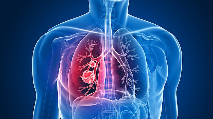 Akciğer kanserinde ölüm oranı nedir? Akciğer kanserinde tedavi yöntemleri