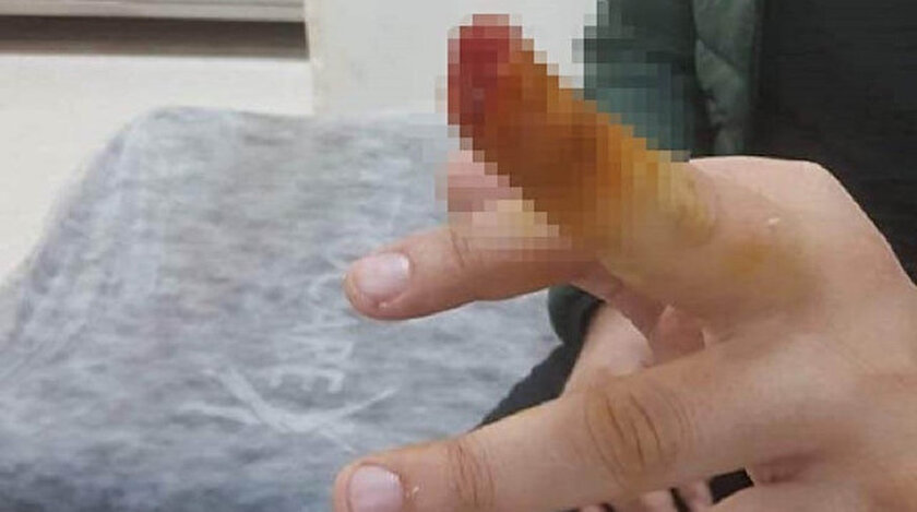 Samsunda dehşet: Tartıştığı güvenlik görevlisinin parmağını ısırıp kopardı