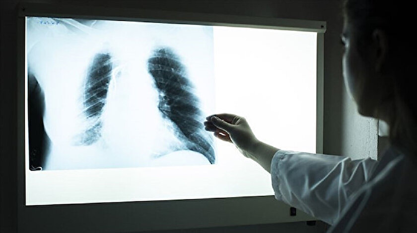 Kovid-19 geçiren hastaların akciğerleri, ksenon gazı kullanılarak yeni bir yöntemle tarandı.