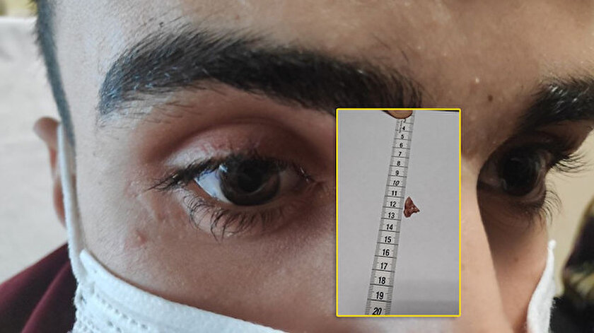 Bir ay boyunca gözünde unutulan cam kırığı ile yaşadı