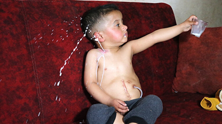 İçtiği sıvı gıdalar boğazındaki delikten geri dökülüyor: Yemek borusu olmayan Muhammed yardım bekliyor