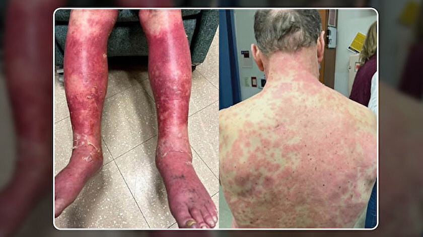 ABDde Johnson & Johnson aşısı kabusu oldu: Vücudunda kızarıklık ve ağrılı döküntü oluştu