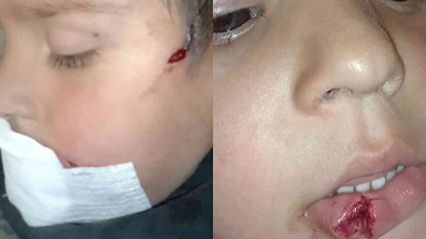 Sokak köpeğin saldırısına uğrayan 3 yaşındaki Mert ölümden döndü