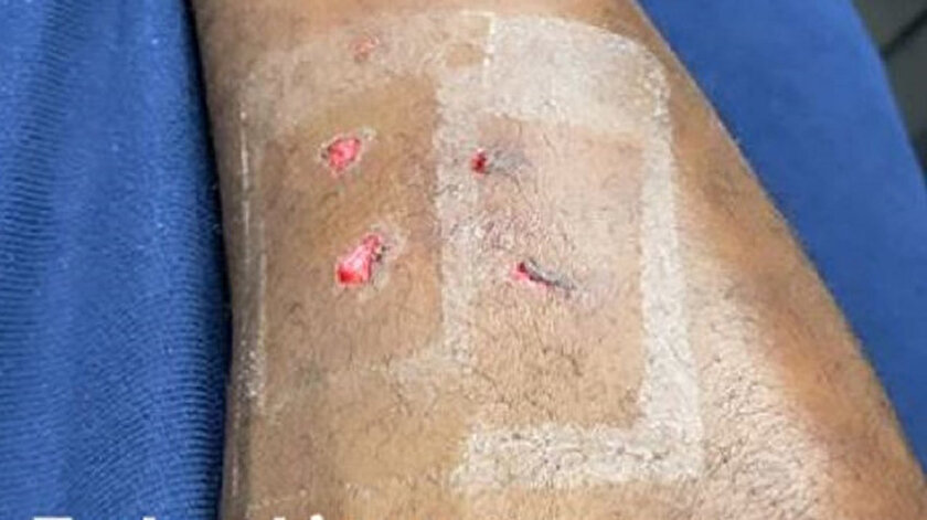 Balotelliden hakem isyanı: Bacağının görüntüsünü paylaştı