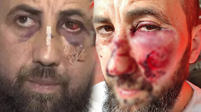 Köln’de ırkçı saldırıya uğradı doktor böyle alay etti: Ölmediğine şükret