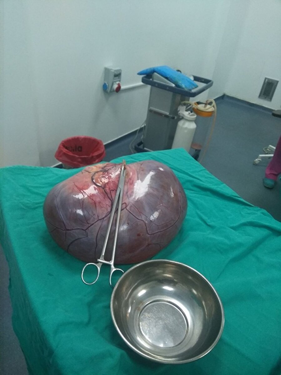 Kilo aldığını sanan kadında 9 kilo kitle çıktı