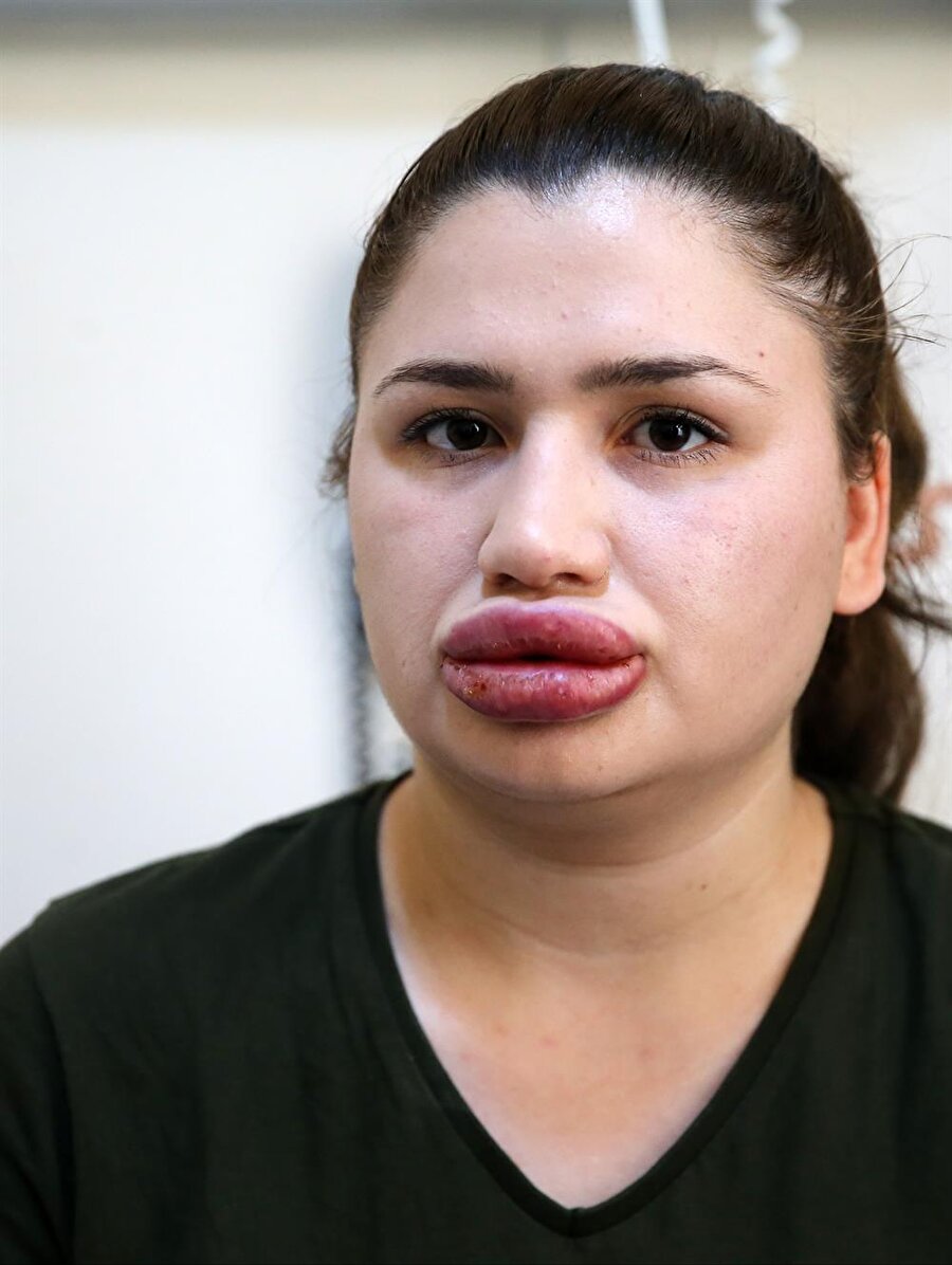 Merve Keleş'in yüzü estetik operasyon sonrası bu hale gelmişti