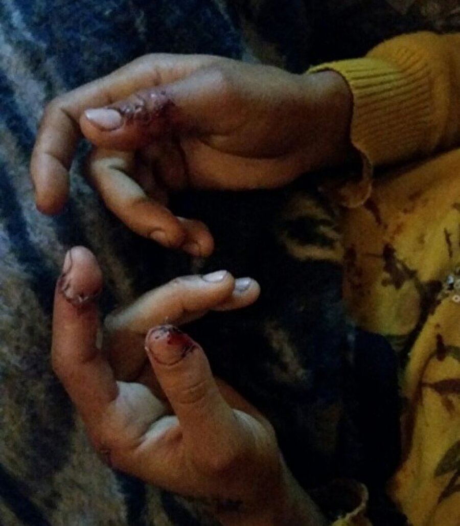 Huriye G.'nin parmaklarının bir bölümü koptu.