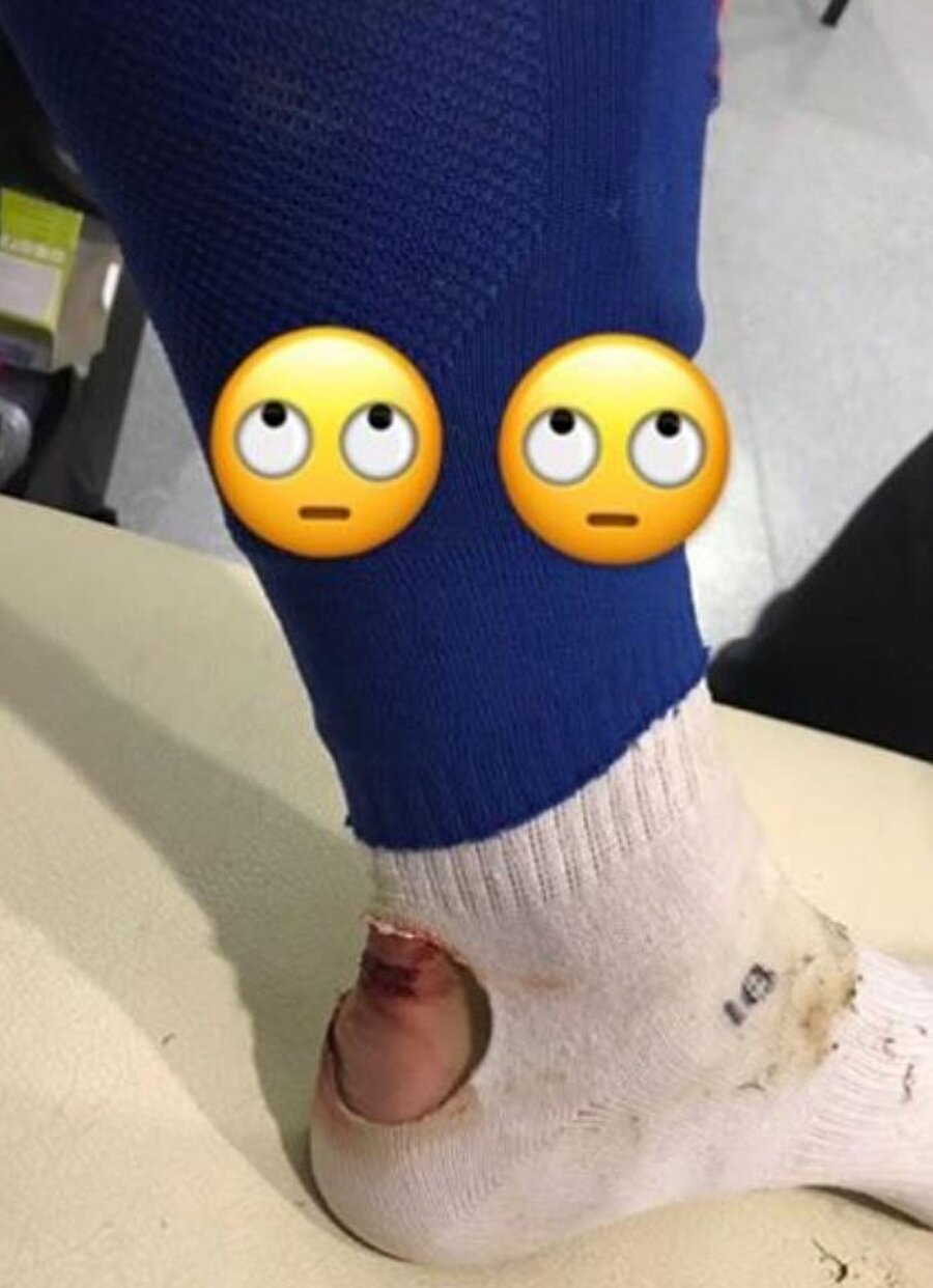 30 yaşındaki futbolcu ayağındaki yaranın fotoğrafını sosyal medya hesabından paylaştı. 
