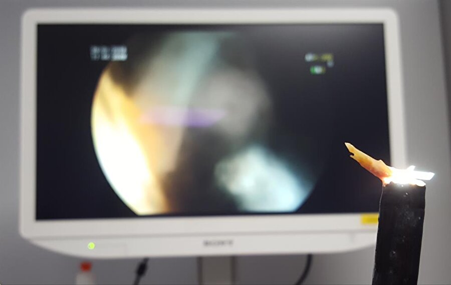 Hastanın yemek borusundan, 2 santimlik tavuk kemiği çıkarıldı.