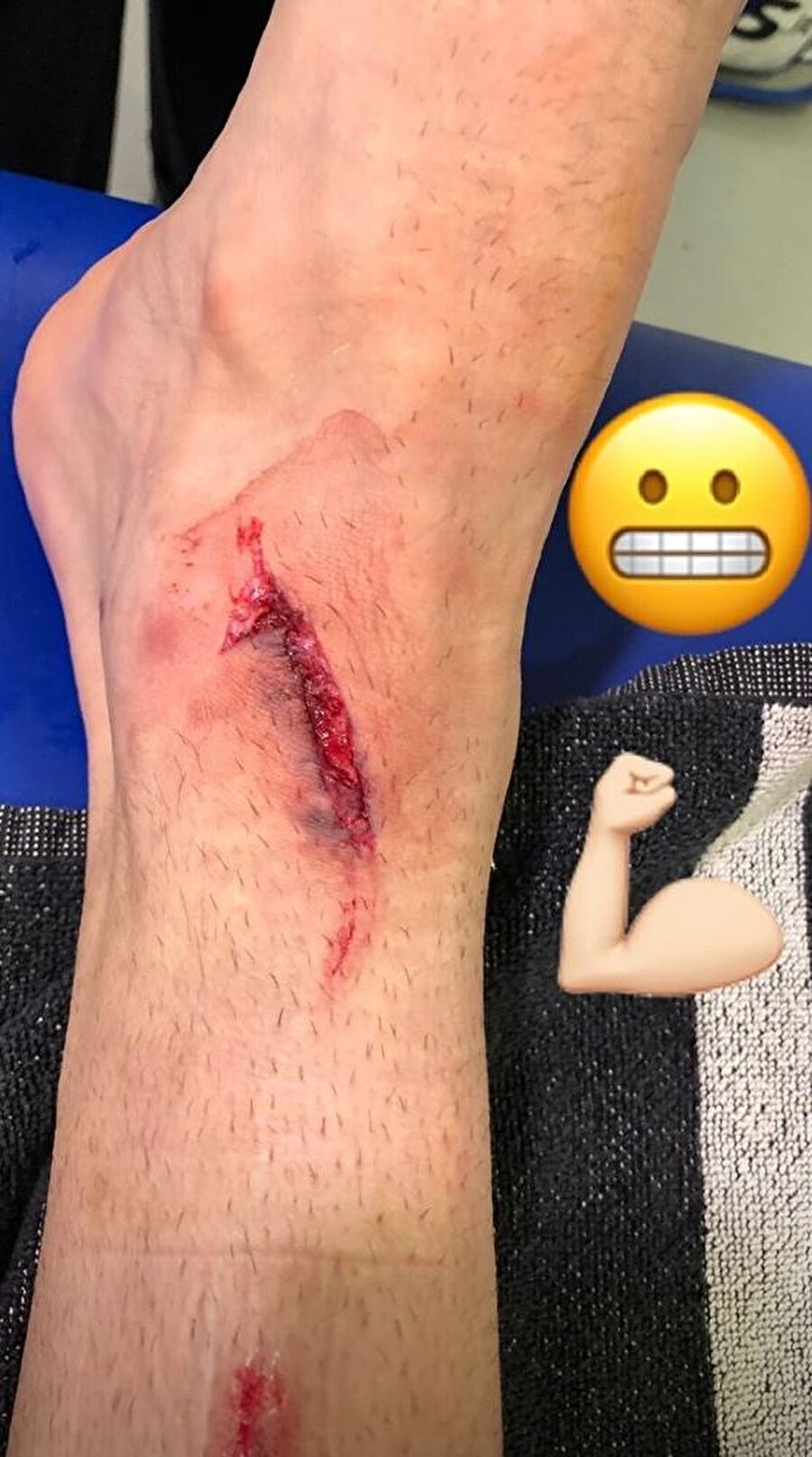 Golcü futbolcu maçtan sonra ayağının son halini sosyal medyadan paylaştı. 