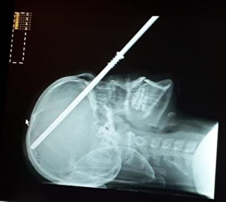 14 yaşındaki çocuğun röntgen görüntüsü.