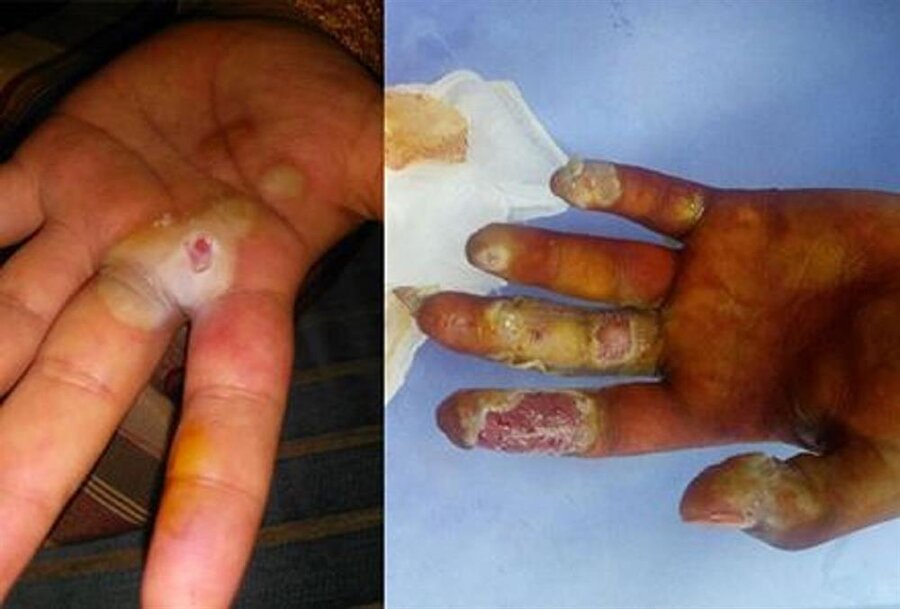  Radyasyon yüklü maddeye 2.5 saat temas eden Eyüp sağ elindeki iki parmağını kısmen kaybetti.