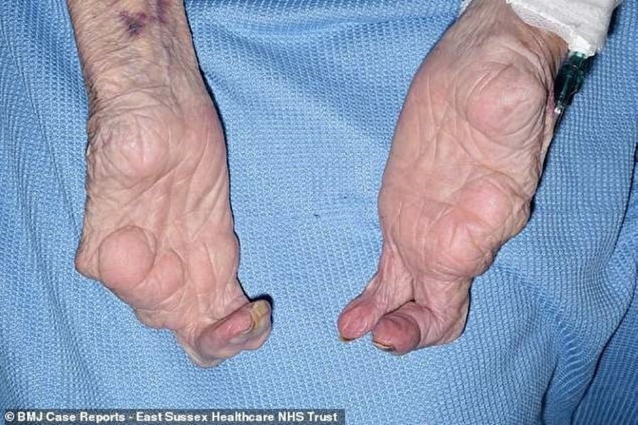 Yaşlı kadın, el ve ayak hastalığı sebebiyle hayatında zorlansa da, yaşama mücadelesini hiç kaybetmedi.