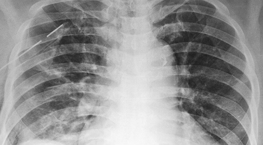 Akciğer sönmesinin teşhisinde ciğerlerin röntgen filmi hayati öneme sahip.