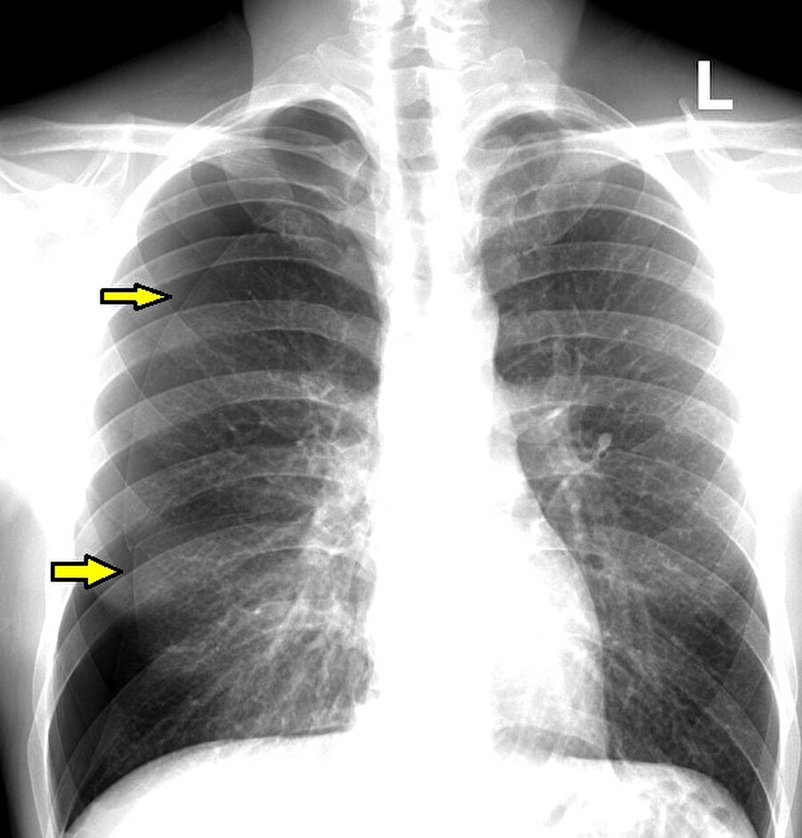 Pnömotoraks teşhisi konmuş bir akciğer örneği.