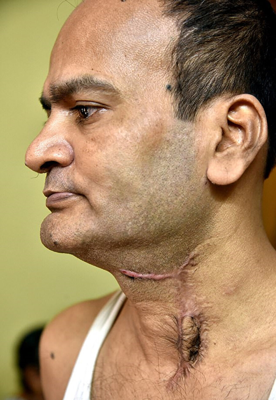 Talihsiz adamın boğazında derin ameliyat izleri kaldı.
