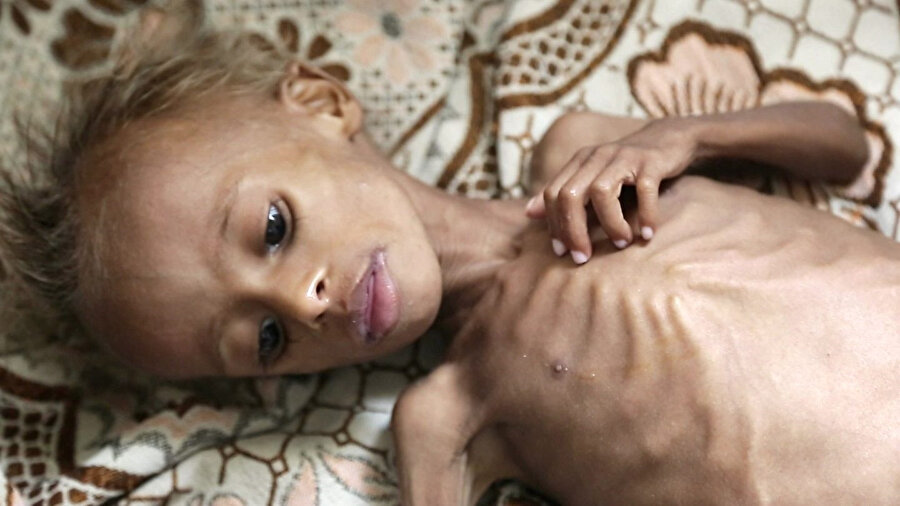 Suudi Arabistan ve İran'ın savaş arenasına dönüşen Yemen'de en büyük sıkıntıyı siviller çekiyor. On binlerce çocuk, açlıktan ölme tehlikesiyle karşı karşıya.