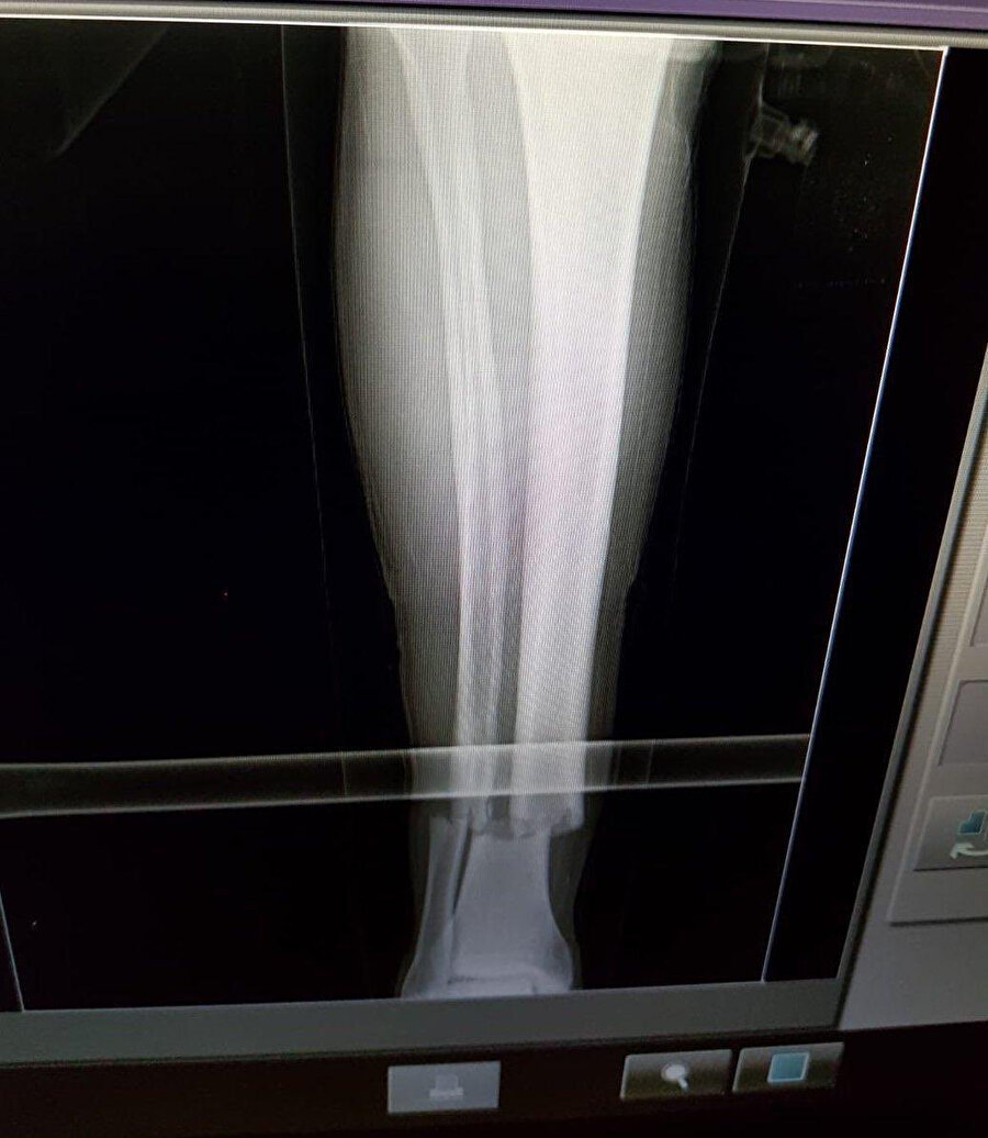 Emre Akbaba'nın sağ ayağının röntgen görüntüsü.