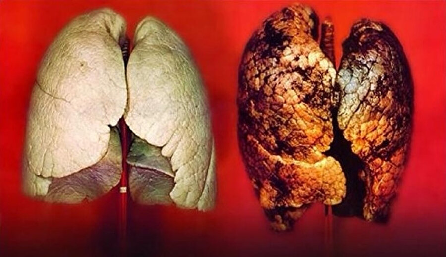 Uzun süreli olarak sigara içmek emfizema adı verilen kronik bloke edici akciğer hastalığına sebebiyet verebilir. Bu durum akciğerin alveoli adı verilen, oksijen ve karbondioksit değişiminin yer aldığı bölümün bir kısmını tahrip ederek kişinin nefes darlığı yaşamasına neden olur...