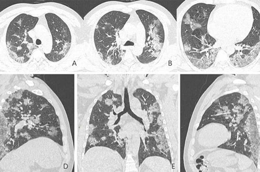 Koronavirüsten ölen kişinin akciğer röntgen filmleri ortaya çıktı