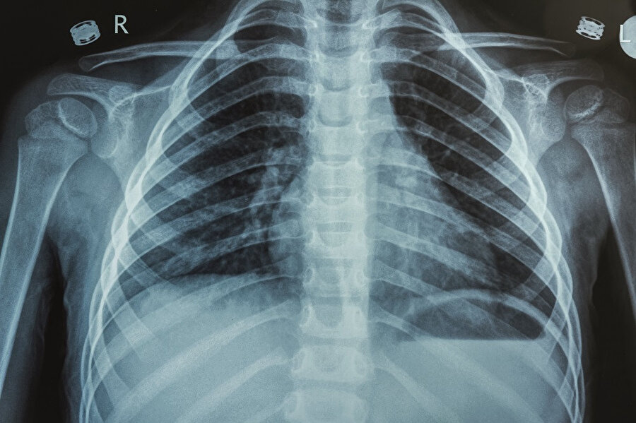 Hastanede koronavirüsteki en büyük belirti akciğerlerin irtifa kaybıdır.