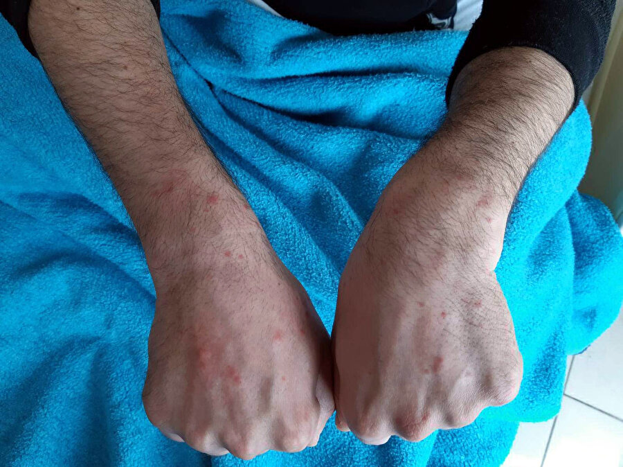 Cerrahpasa Daki 210 Hasta Incelendi Covid 19 Un Deriye Etkisi Nedir