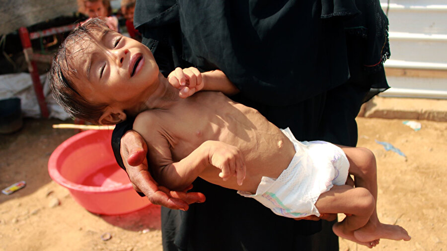 Yetersiz beslenme dolayısıyla tedavi altına alınan 10 aylık Yemenli bir bebek.