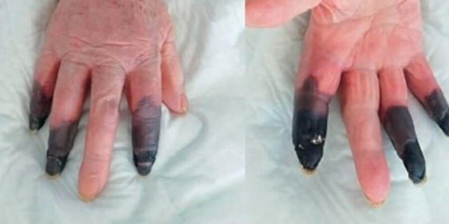 Kangren nedeniyle üç parmağı kesildi
