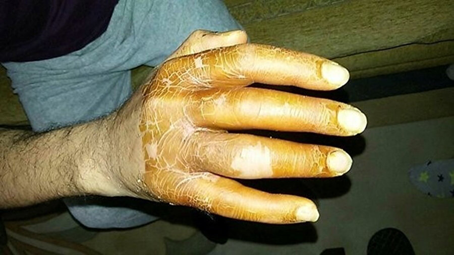 Türkmen'in eli kürdan batması sonrası kızarıp şişmeye başladı