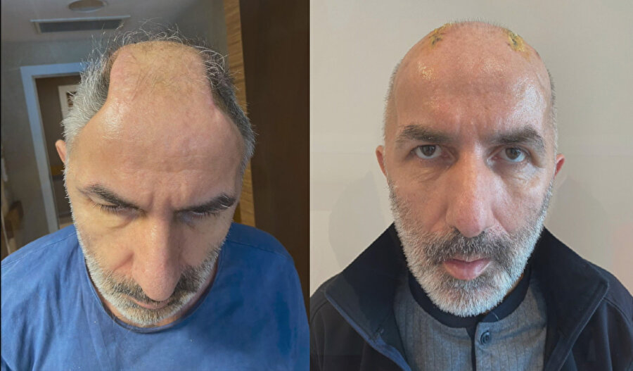 5 ay karnında taşıdığı kafatası kemikleri onu ikinci kez hayata bağladı