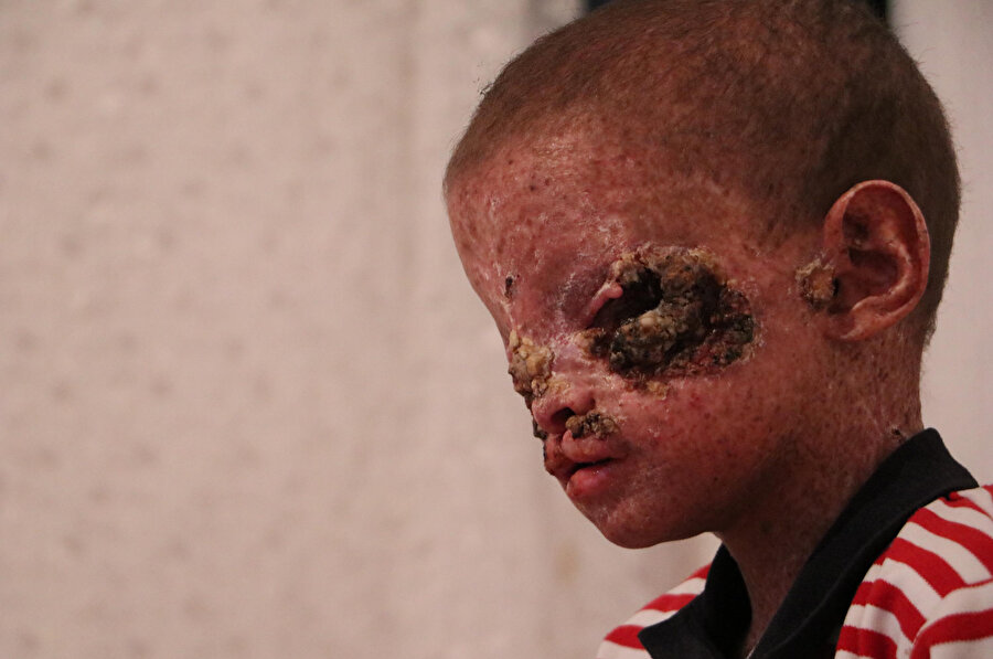 Cilt kanserinden gözleri kapanan küçük Salih: Ailemi görmek istiyorum