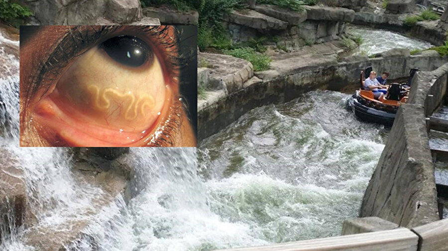  ABD'de yaşayan Robert Trostle isimli şahıs, Kennywood eğlence parkında rafting yaptığı sırada göz yiyen bir parazit kaptığını iddia ederek, eğlence parkına 35 bin dolar tazminat davası açtı. 
