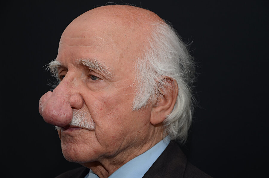 Burnunu kurcaladıkça büyüdü: Nefes alamayınca soluğu hastanede aldı