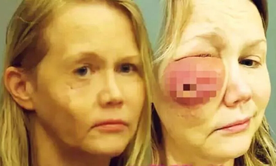 Estetik faciası: Güzelleşmek isterken yüzünde kocaman delik açıldı