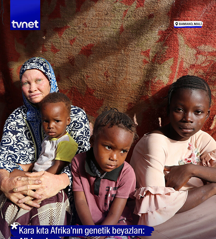 Kara kıta Afrika'nın genetik beyazları: Albinoslar