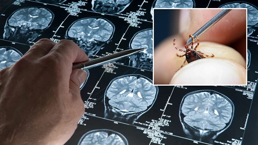 Keneler tarafından taşınan bir virüs