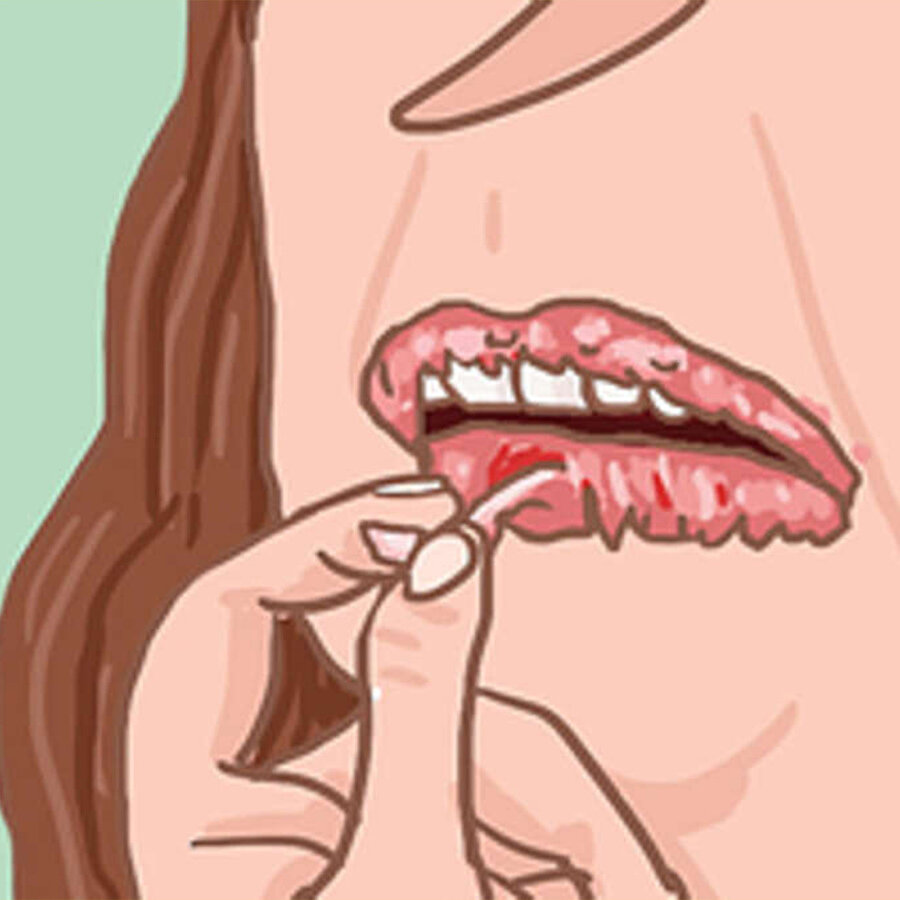 Sivilce mağdurları anladı bile