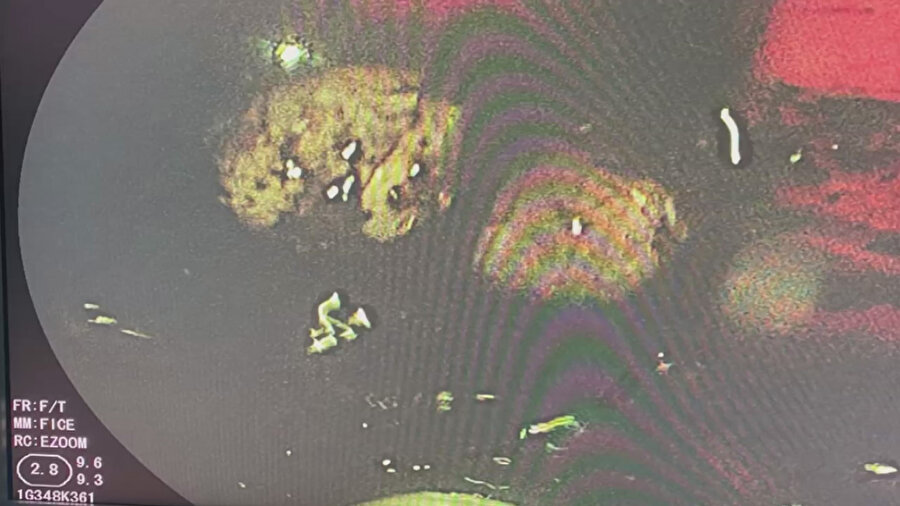 Midesinde patladı: Hayatına mal oldu