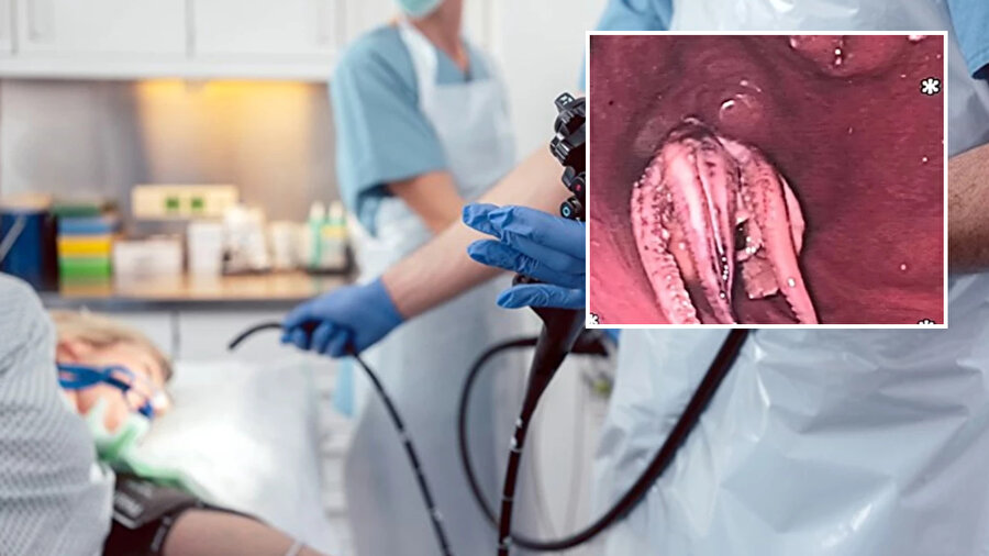 Yemek yedikten sonra rahatsızlanan adamın boğazından doktorlar ahtapot çıkardı