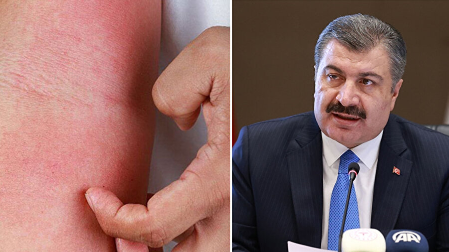 Bakan Koca, artan uyuz vakası haberlerine ilişkin açıklamada bulundu.