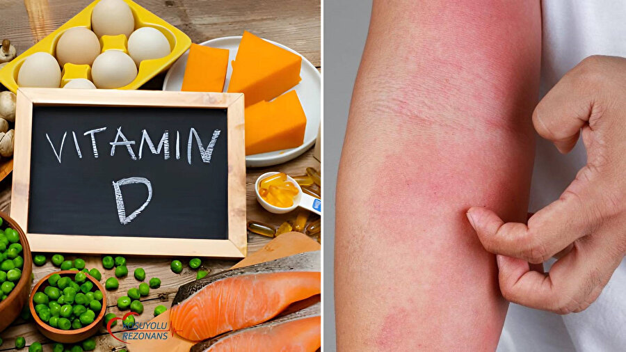 ​Gıda alerjileri gün geçtikçe neden artıyor?