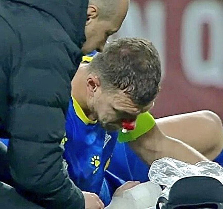 Burnu kırılan Edin Dzeko'nun son durumu belli oldu