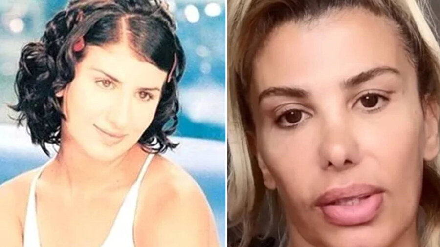 Şarkıcı Hatice botokstan zehirlendi: Son haliyle açıklama yaptı