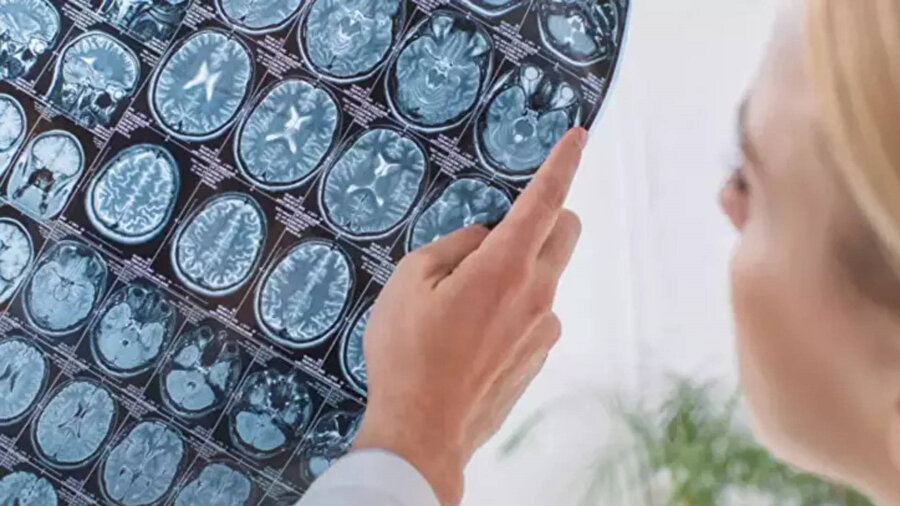 Beyin kanaması geçirdi: Bir süre kafatası parçasını midesinde taşıdı