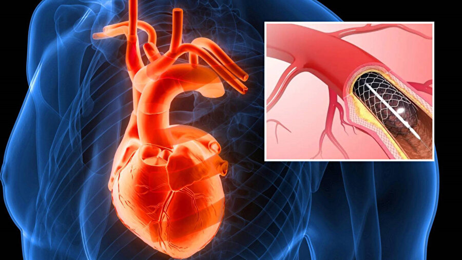 ​Aort damarı nedir, neden yırtılır? Belirtileri ve tedavi süreci