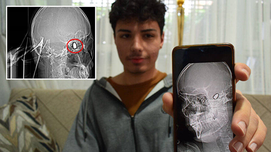 Her günü ölüm korkusuyla geçiriyor: 1,5 yıldır başında mermiyle yaşıyor